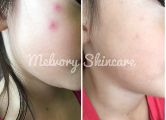 Mozzie Balm ( 10ML)