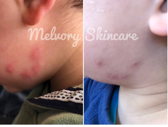 Mozzie Balm ( 10ML)