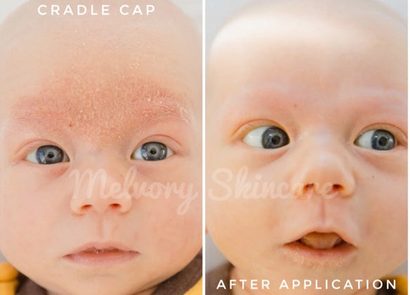 Baby Bum Balm